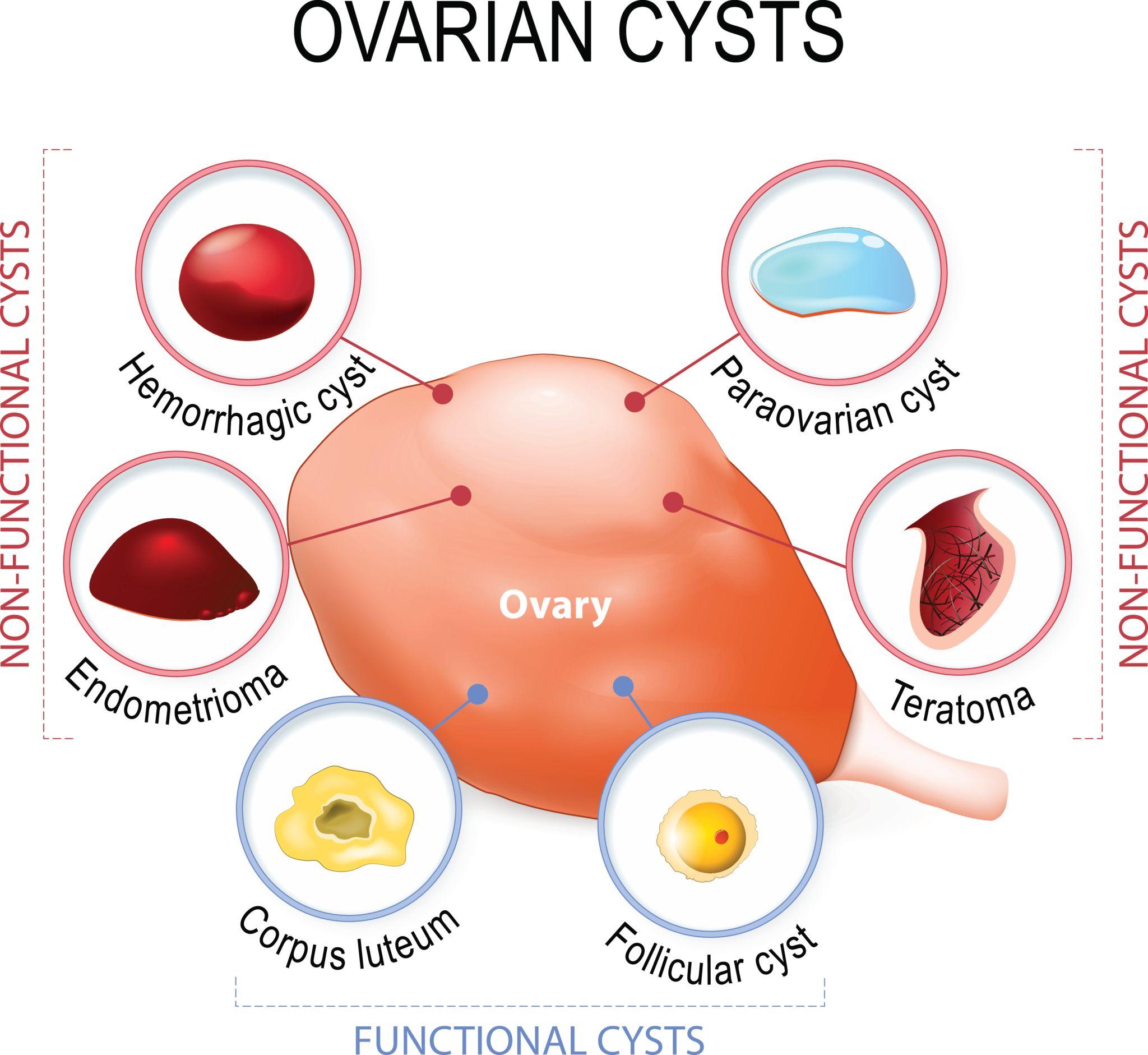 Laparoscopic Ovarian Cyst Removal in Pune – Safe & Advanced Treatment